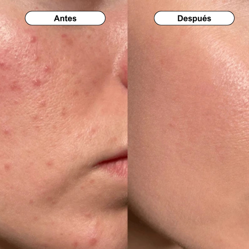 Dr. Althea 345 | Crema Calmante Anti Acné y Rosacea
