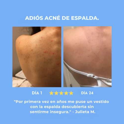 Lunara Soap | Trata y previene el acné en la espalda y el cuerpo