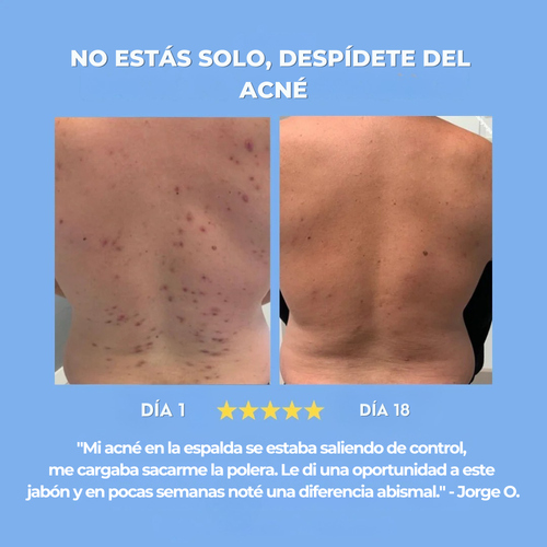 Lunara Soap | Trata y previene el acné en la espalda y el cuerpo