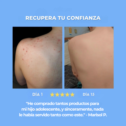 Lunara Soap | Trata y previene el acné en la espalda y el cuerpo